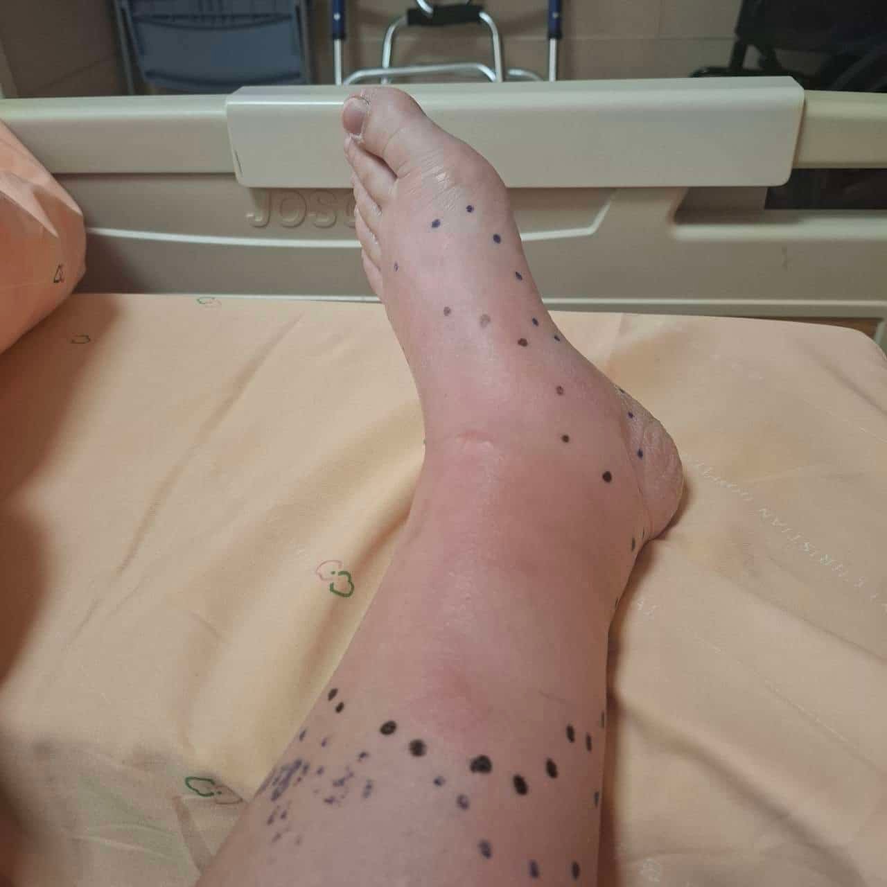 腳癢脫皮不是小事 嘉基提醒慎防蜂窩性組織炎上身 4 IMG 5065